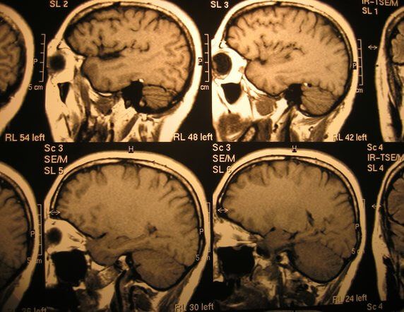 Como surge o câncer: visão da Germânica Heilkunde