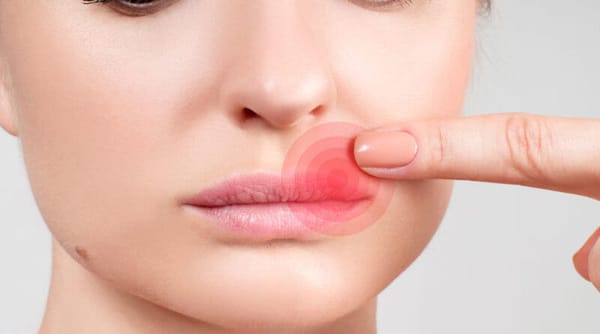 Herpes genital e labial: Quais são as causas?