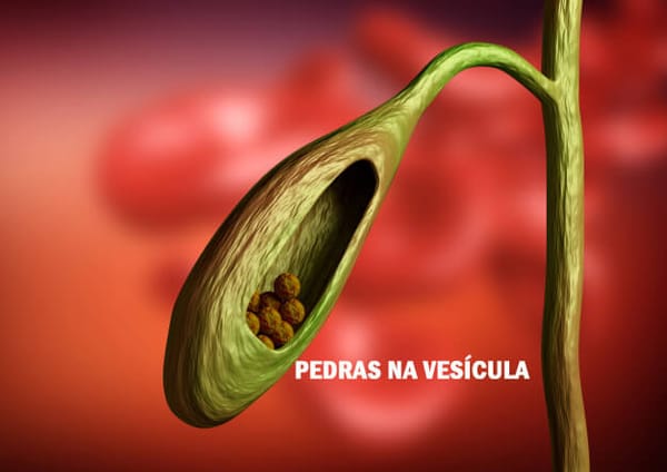 Pedra na vesícula (cálculo biliar) pela Medicina Germânica Heilkunde