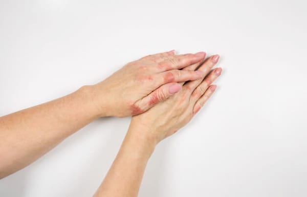 Eczema das mãos segundo a Medicina Germânica Heilkunde
