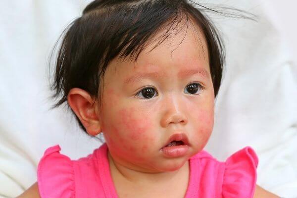 Alergia de pele em crianças pela Germânica Heilkunde