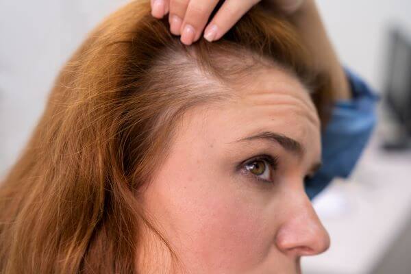 O que é alopecia pela Medicina Germânica Heilkunde?