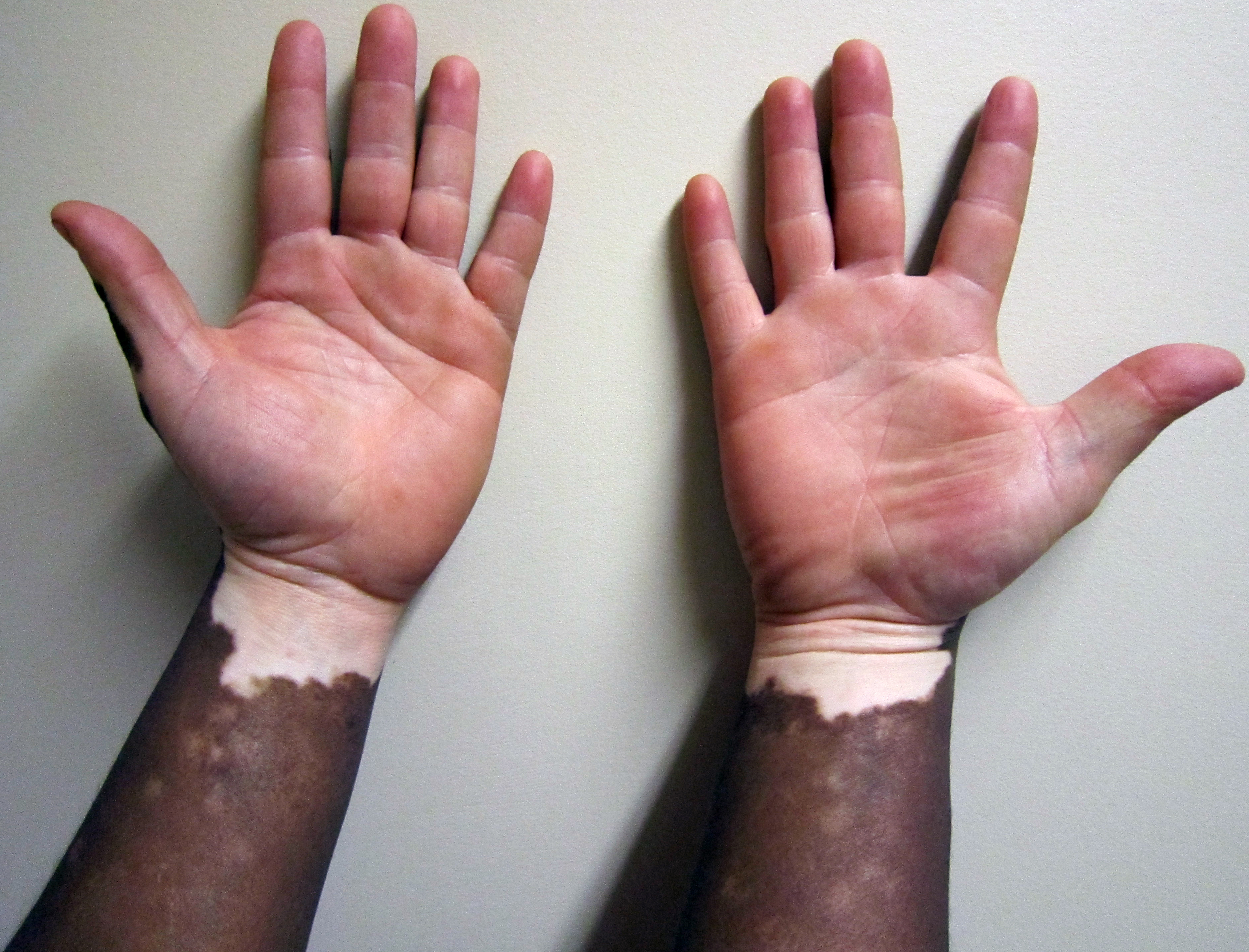 Quais são as causas do vitiligo?